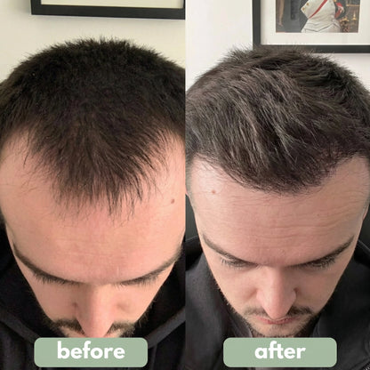 Advanced Hair Density Roll-On